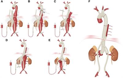 Impact of frozen elephant trunk on the outcomes of thoracoabdominal aortic repair with normothermic iliac perfusion